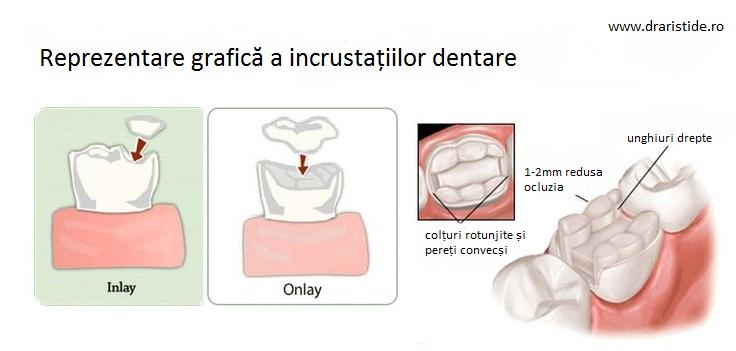 incrustatii dentare dr aristide
